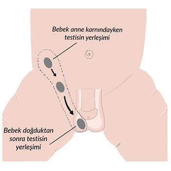 Bebeklerde İnmemiş Testis